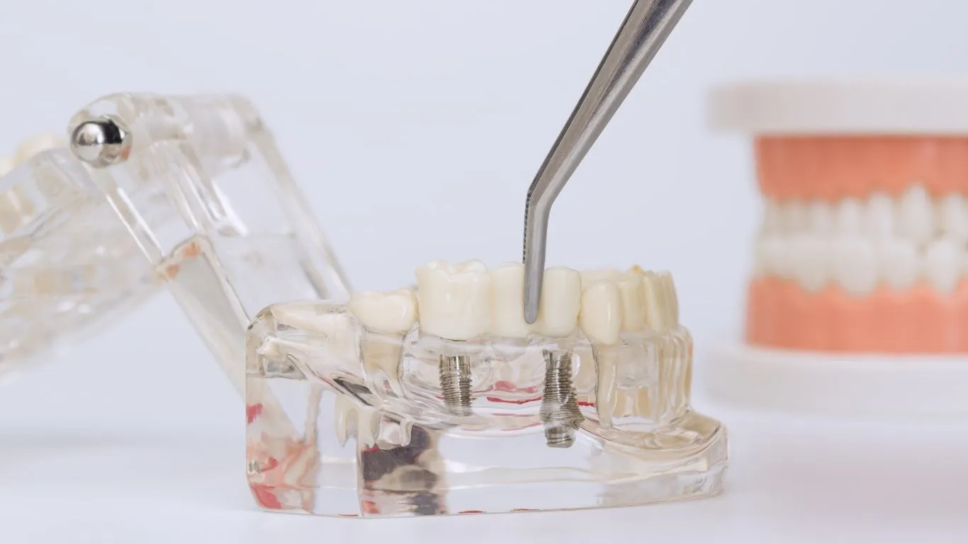 how long do dental bridges last