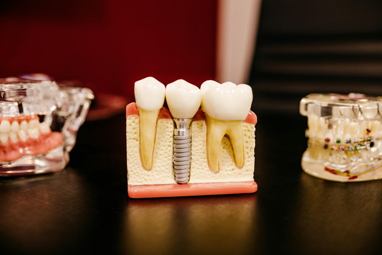 root canal therapy
