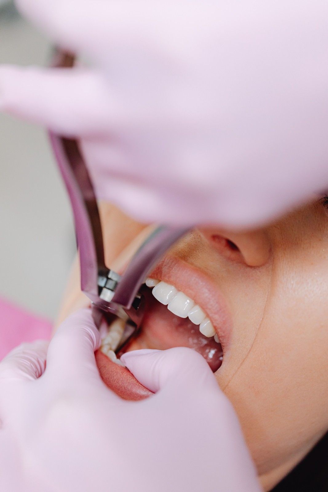 emergency tooth extraction