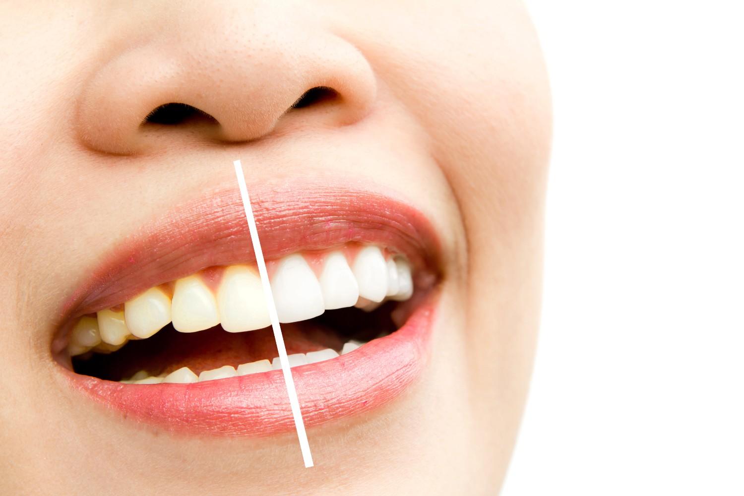 Teeth Whitening treatment