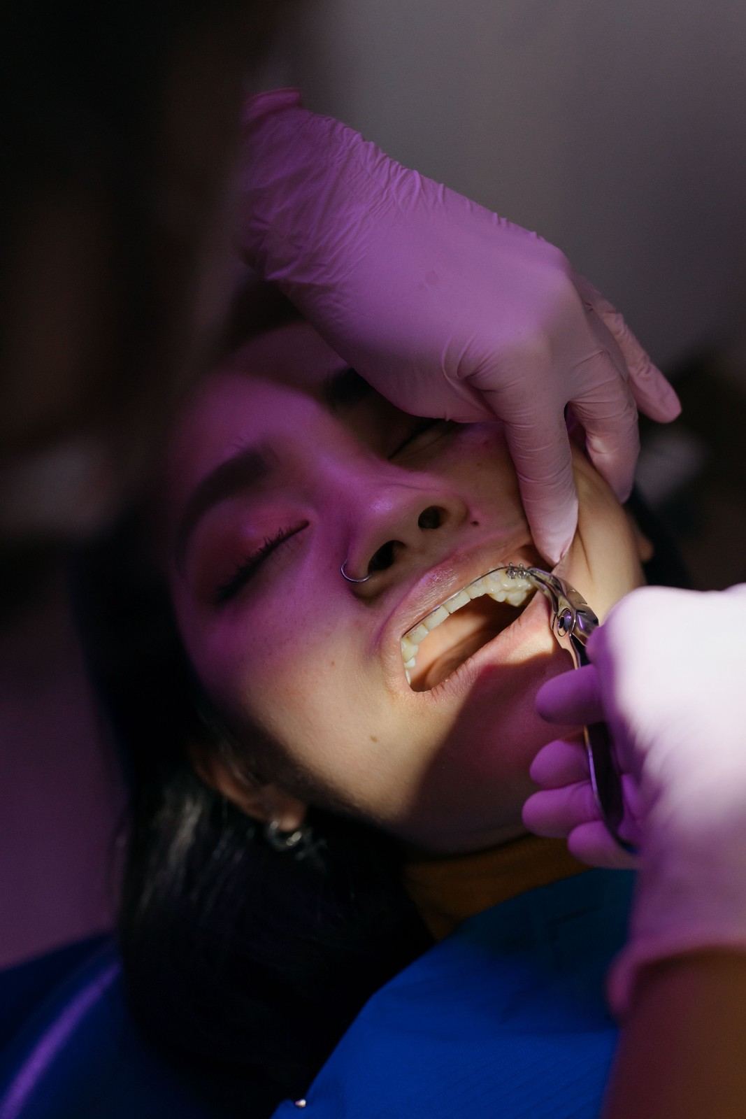 Dry Socket After Tooth Extraction